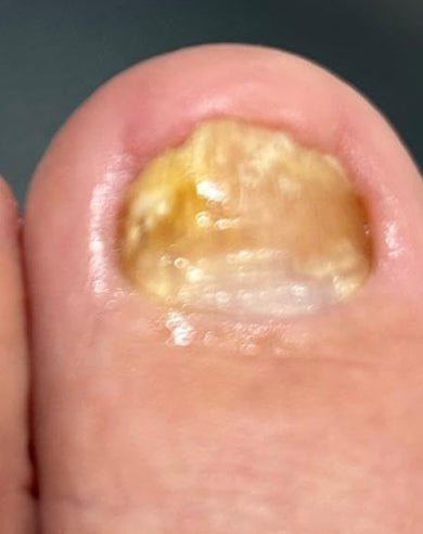 After treatment
