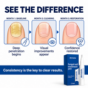 Fungal nail treatment pen for toenails and fingernails - 4 Pens